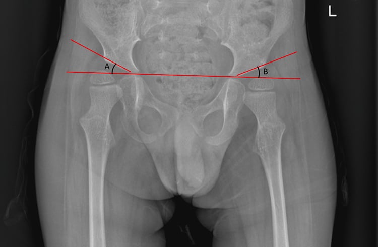 Pelvic radiograph demonstrating bilateral acetabular-index measurements in a child with SMA.