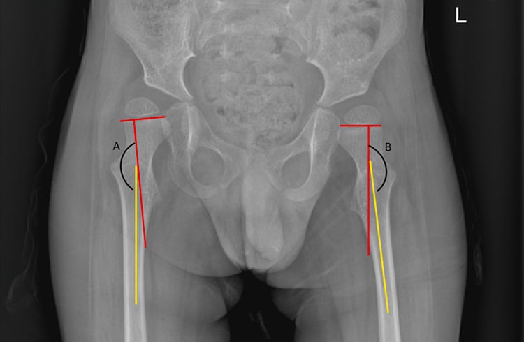 Pelvic radiograph demonstrating bilateral femoral head-shaft-angle measurements in a child with SMA.