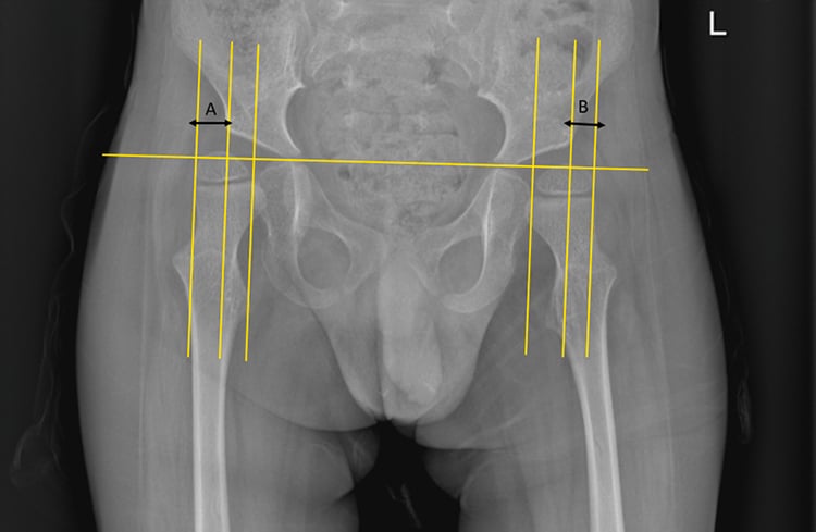 Pelvic radiograph demonstrating bilateral Reimer migration-percentage measurements in a child with SMA.