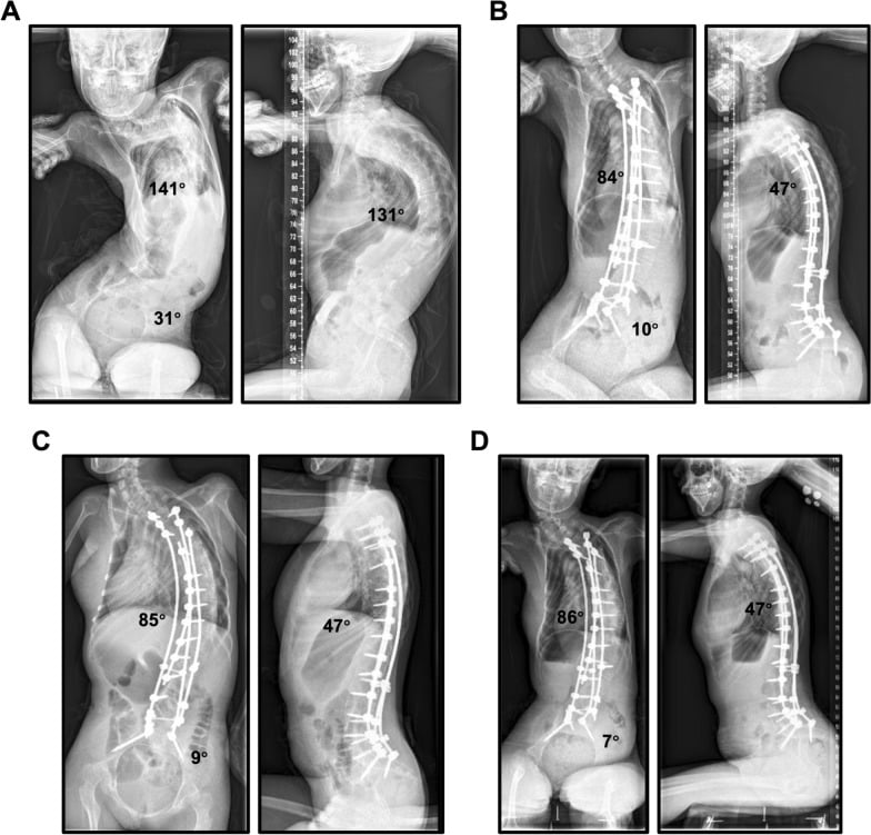 Serial seated whole-spine radiographs before and after SMA scoliosis fusion with traditional iliac pelvic fixation.