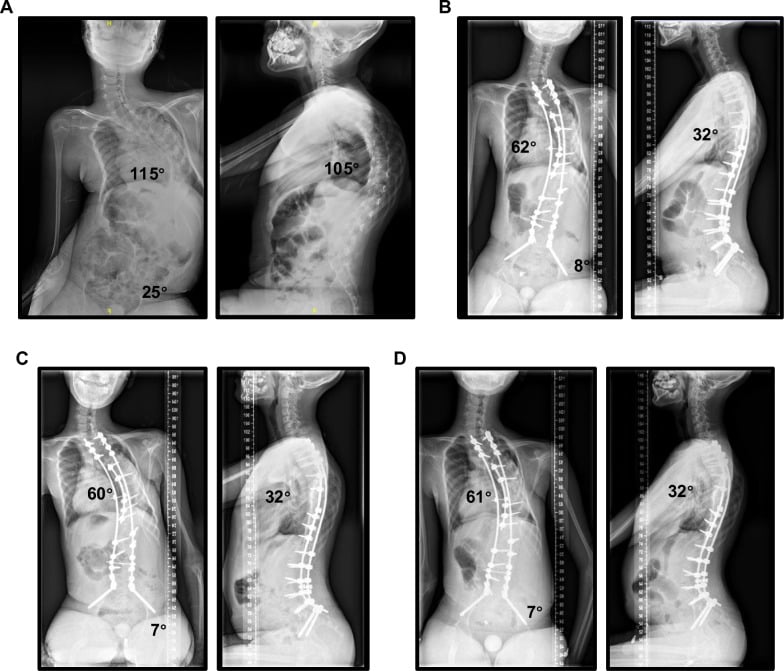 Serial seated whole-spine radiographs before and after SMA scoliosis fusion with S2-alar-iliac pelvic fixation.