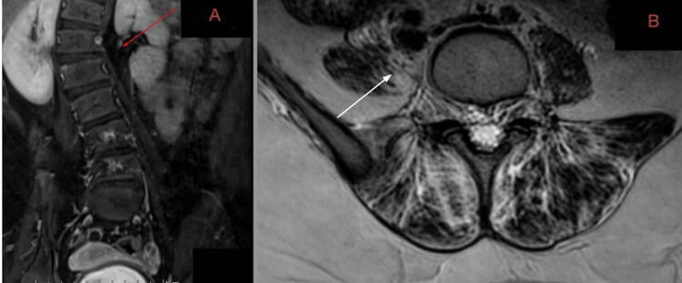 Coronal and axial MRI showing thoracolumbar scoliosis with fatty atrophy of the paraspinal muscles in SMA type III.