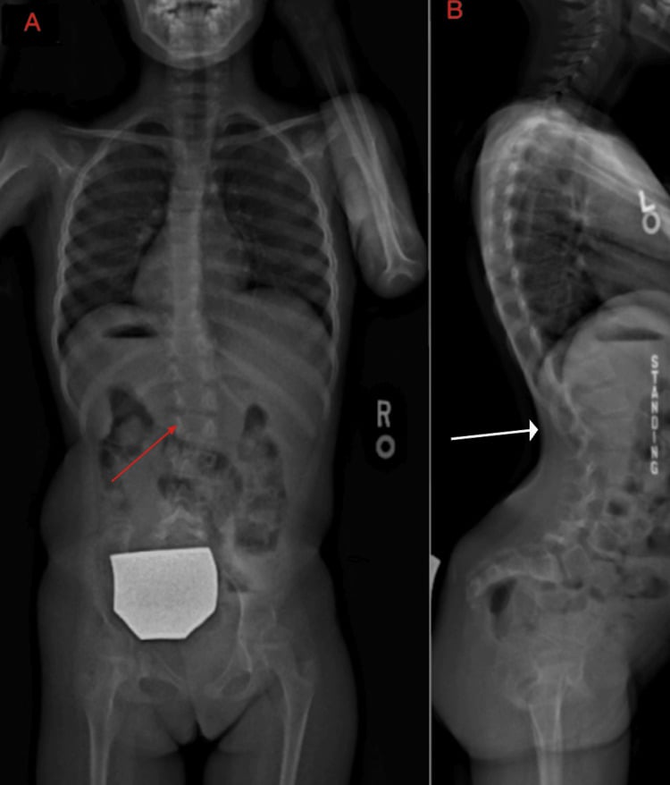 Frontal and standing lateral spine radiographs showing thoracolumbar neuromuscular scoliosis in SMA type III.