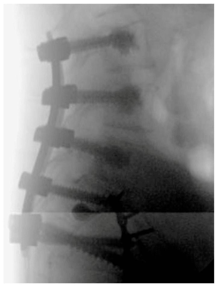 Lateral fluoroscopy during reduction with lumbopelvic instrumentation