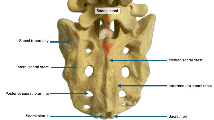 Posterior sacral anatomy showing the canal and neural foramina