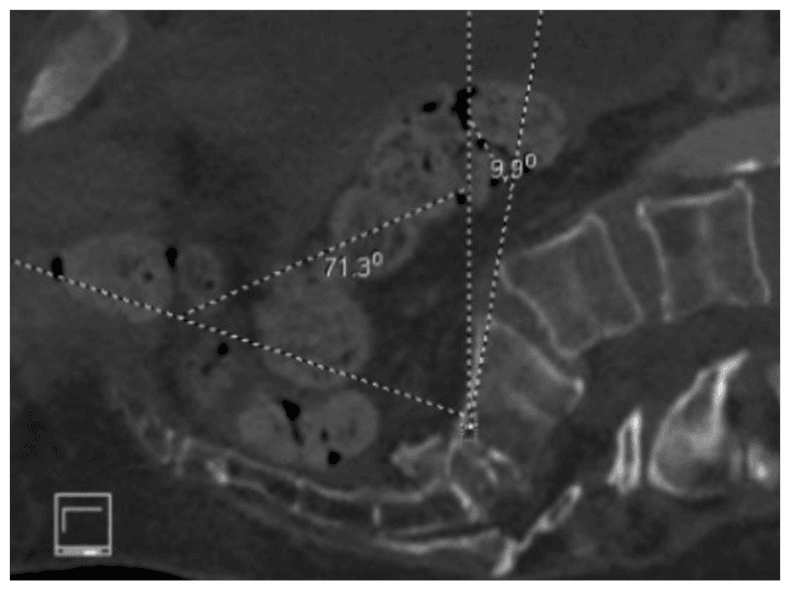 Sagittal CT showing severe sacral kyphosis and outlet angulation