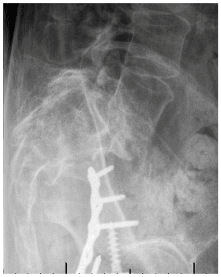 Lateral radiograph showing L5-S1 translation and sacral kyphosis
