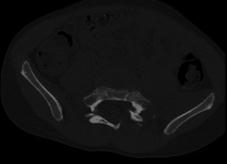 CT showing bilateral sacral-wing and transverse S2 fracture components