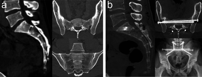 CT and reconstruction of traumatic U-shaped spinopelvic dissociation