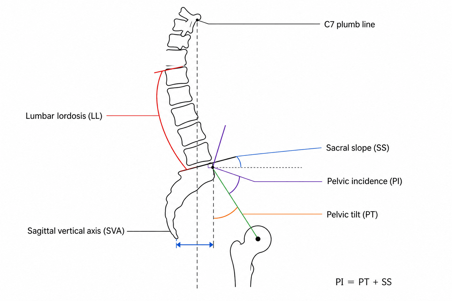 Diagram of the spinopelvic parameters on a lateral view of the spine and pelvis.