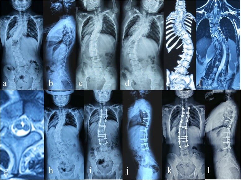 Serial radiographs, CT and MRI from a patient with rigid congenital scoliosis and type II split cord malformation before traction, after traction, after posterior correction and at 36 months.