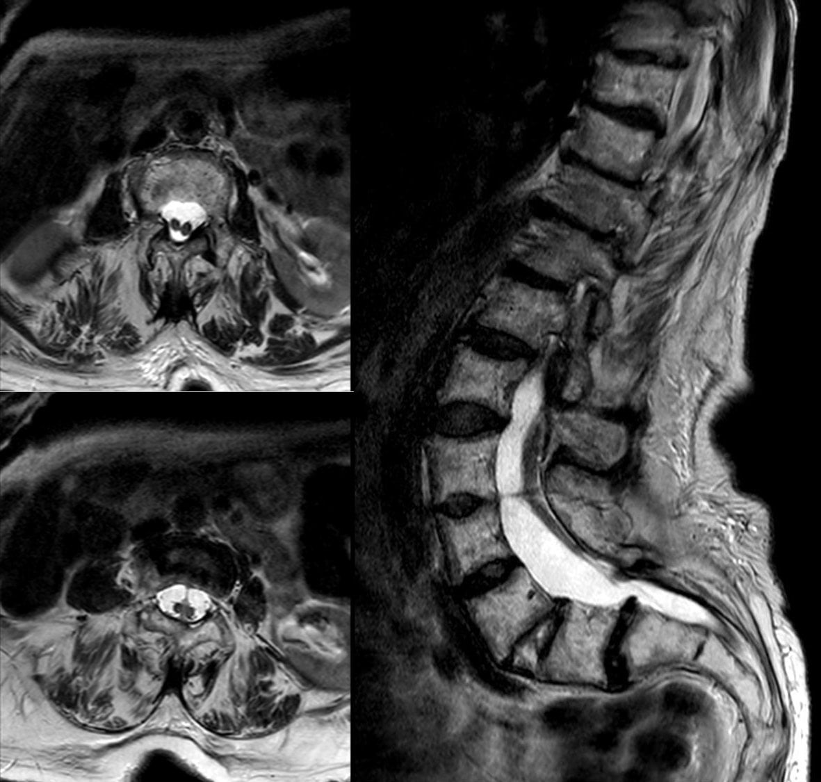 Three-panel T2 MRI of diastematomyelia: two axial images each showing two hemicords within the thecal sac, plus a sagittal lumbar view.