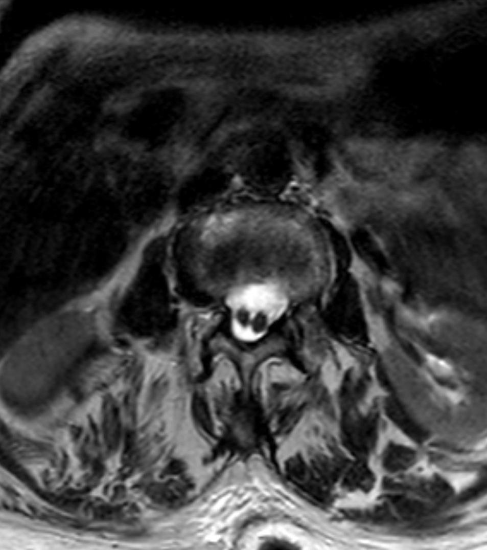 Axial T2-weighted MRI of the spine showing the spinal cord split into two hemicords within the thecal sac, the hallmark of diastematomyelia.