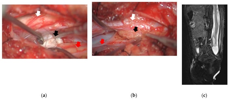 Intraoperative views of rostral and caudal split cord anatomy with associated dermoid and lipoma, plus postoperative sagittal T2 MRI after untethering.