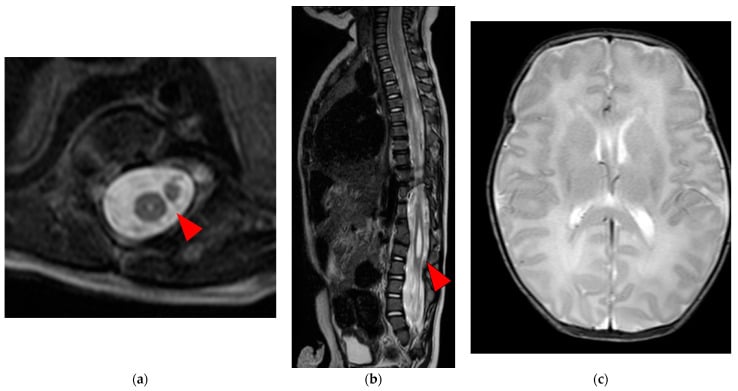 Axial and sagittal T2-weighted MRI in a neonate showing type II split cord malformation within a single dural sheath and an associated syrinx.