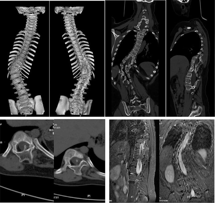 Composite preoperative imaging of severe congenital scoliosis with split cord malformation, including three-dimensional CT, coronal and axial CT, and sagittal and coronal MRI.