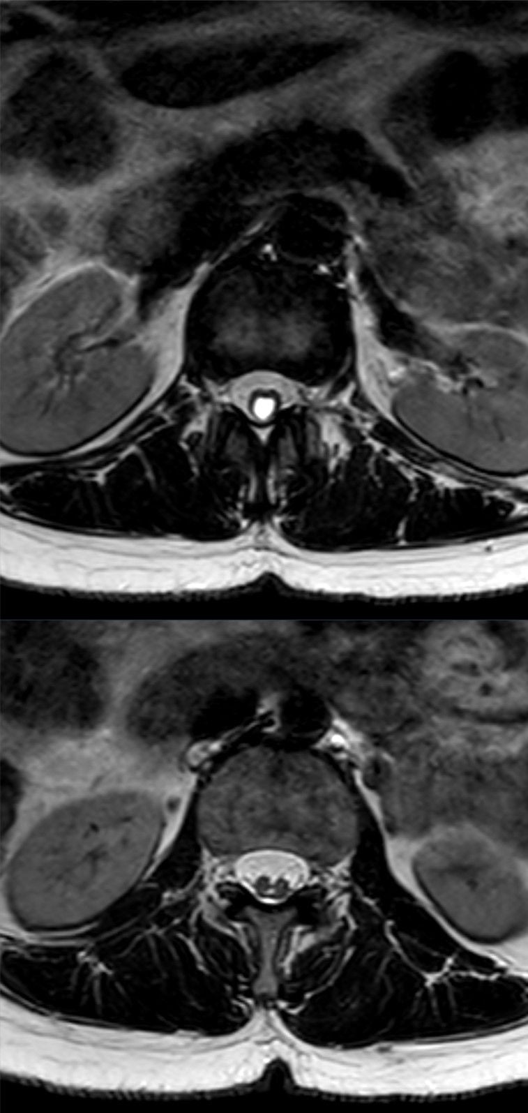 Axial T2 MRI showing a central CSF-intensity syrinx cavity within the spinal cord (syringohydromyelia) in a case of diastematomyelia.