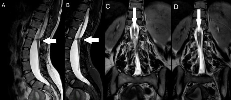 Sagittal T2 and STIR plus coronal T2 MRI showing a chondro-osseous septum, bifid spinal cord and distal rejoining of the hemicords in type I split cord malformation.