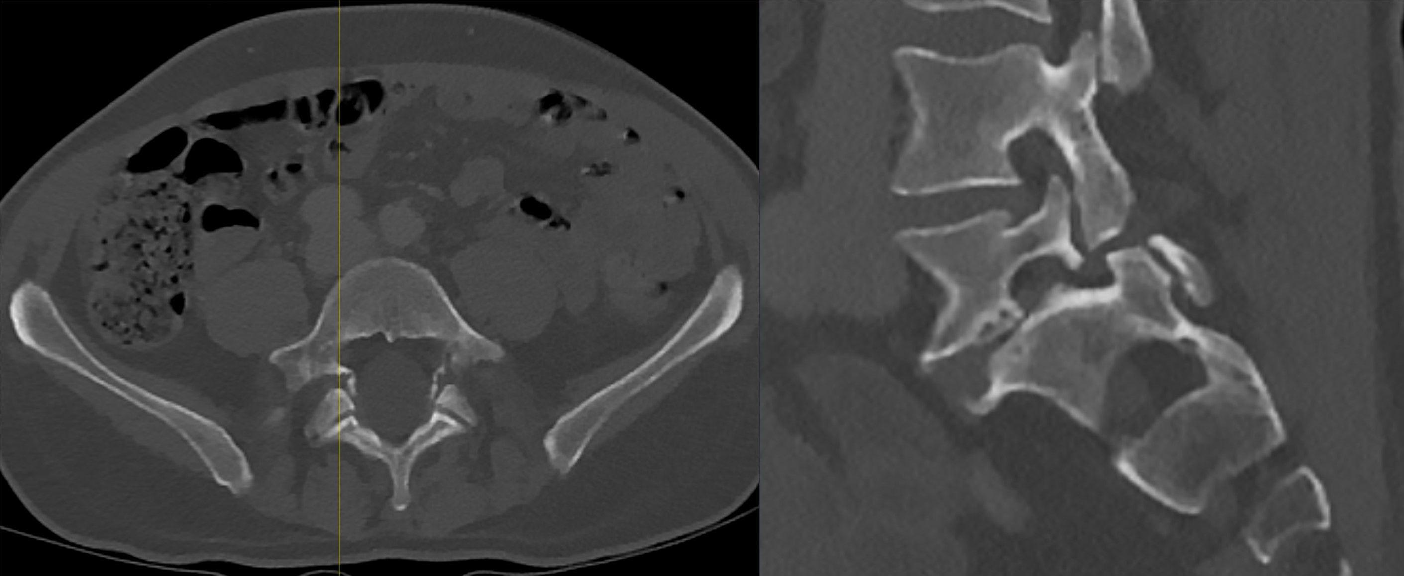 Two-panel CT of isthmic spondylolisthesis in adult anatomy: an axial image through the lumbar posterior arch with a defect on each side, and a sagittal reconstruction of the lower lumbar spine and sacrum.