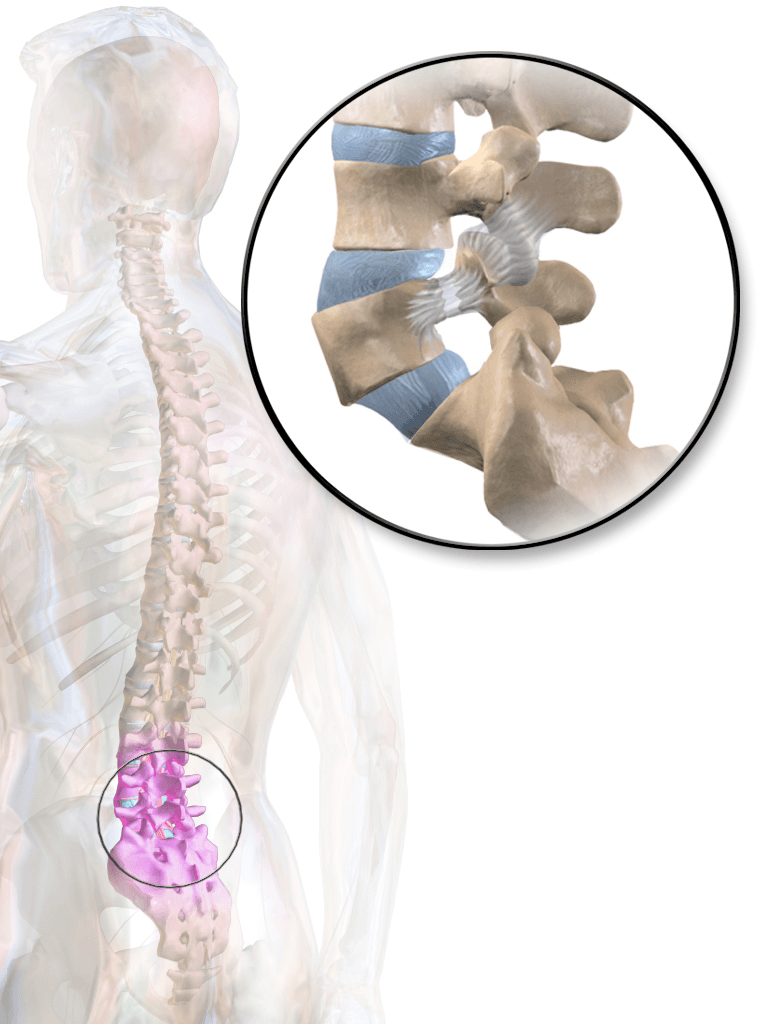 Medical illustration of spondylolysis showing the pars interarticularis defect in the lumbar spine