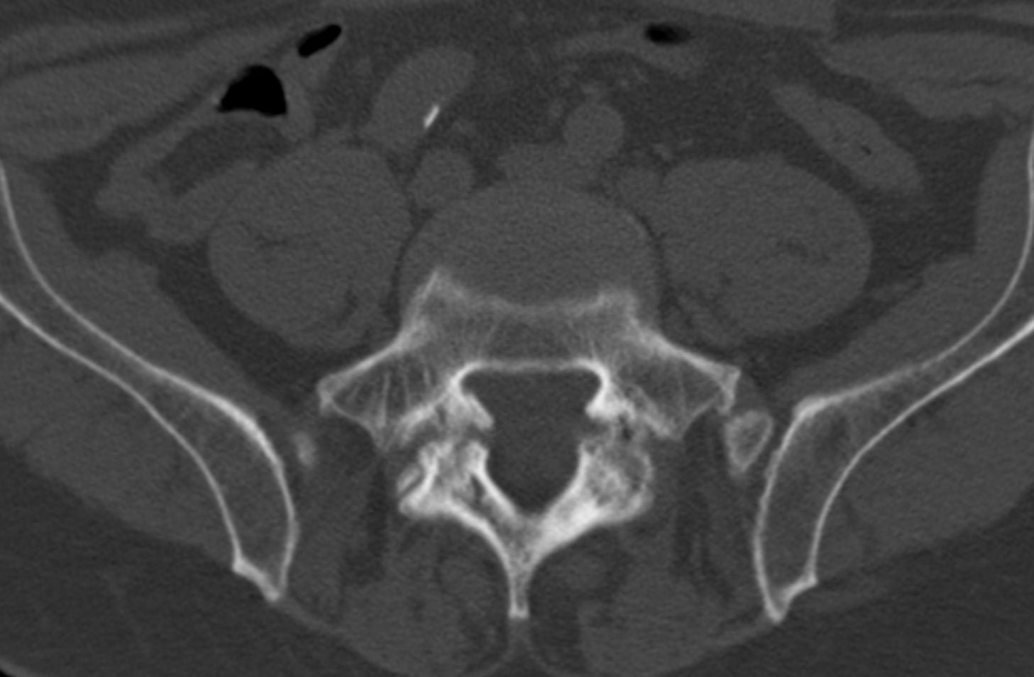 Axial CT of L5/S1 showing bilateral pars interarticularis defects