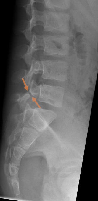 Lateral lumbar radiograph of an 11-year-old showing an L5 pars interarticularis defect (arrows)