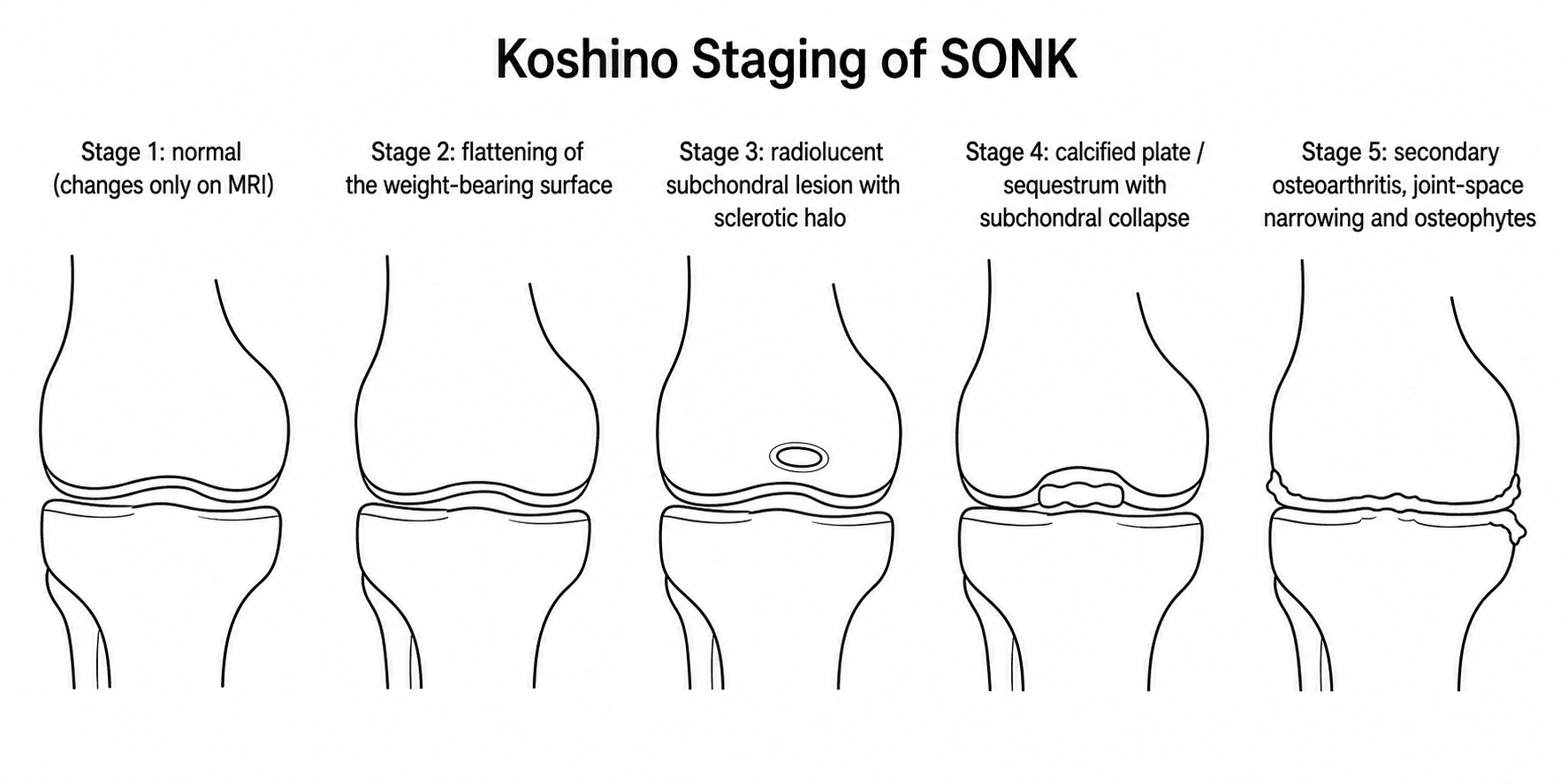 Koshino five-stage schematic of spontaneous osteonecrosis of the knee.