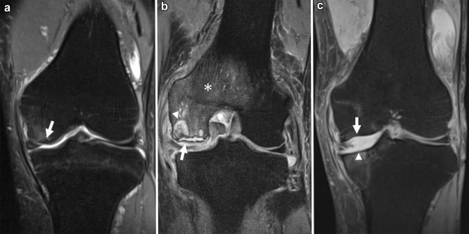 Serial coronal MRI showing progression from a subchondral fracture line to fluid cleft, necrotic fragments and osteochondral collapse.