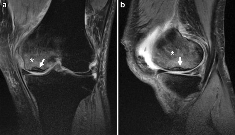 Coronal and sagittal fat-suppressed proton-density MRI showing early medial femoral condyle SIFK with extensive marrow oedema.