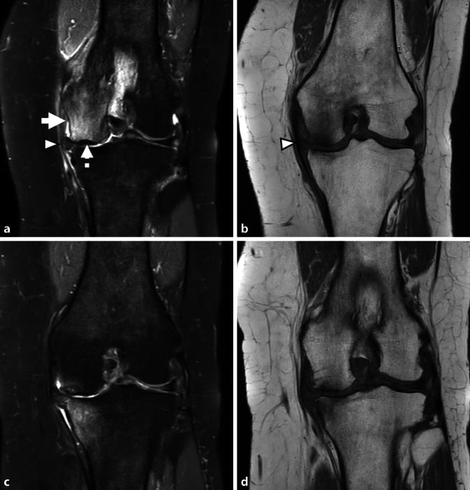 Serial MRI showing high-grade medial femoral condyle SIFK progressing to advanced medial-compartment osteoarthritis.