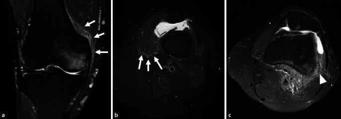 Coronal and axial fluid-sensitive MRI showing the metaphyseal burst sign and peri-femoral soft-tissue oedema in SIFK.