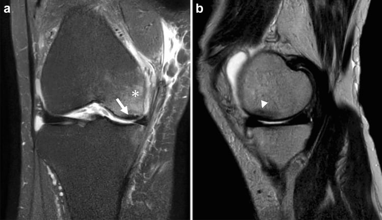 Coronal and sagittal MRI showing a subchondral low-signal band and fracture line in medial femoral condyle SIFK.