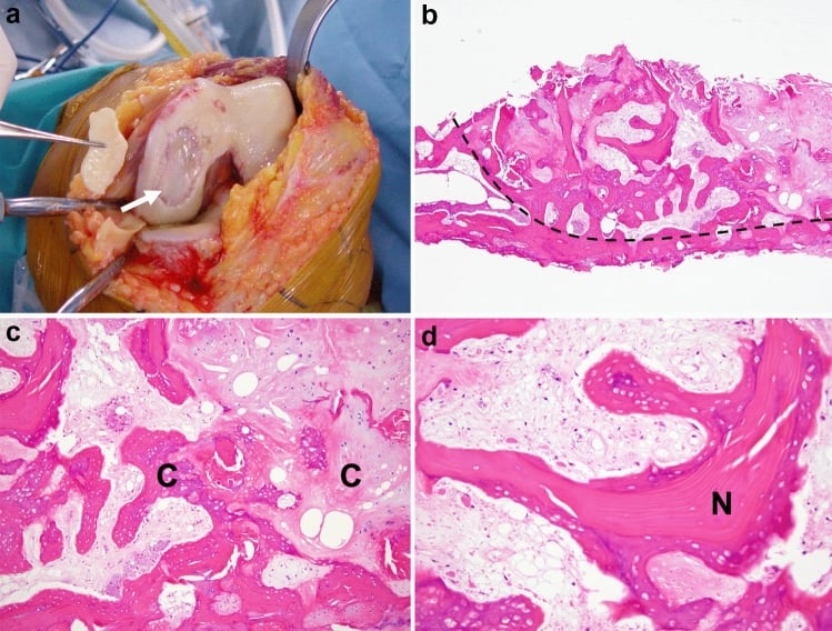 Operative osteochondral specimen and histology from subchondral insufficiency fracture of the medial femoral condyle.