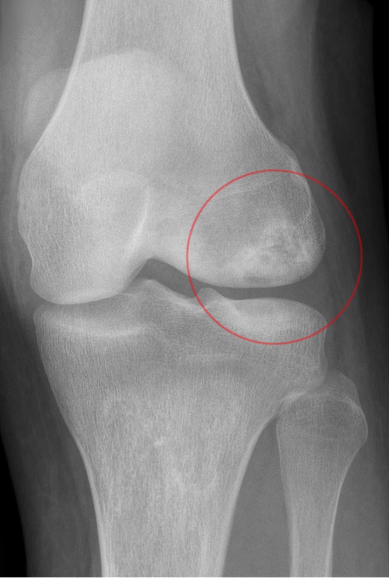 AP knee radiograph with a lateral femoral condyle SONK lesion circled.