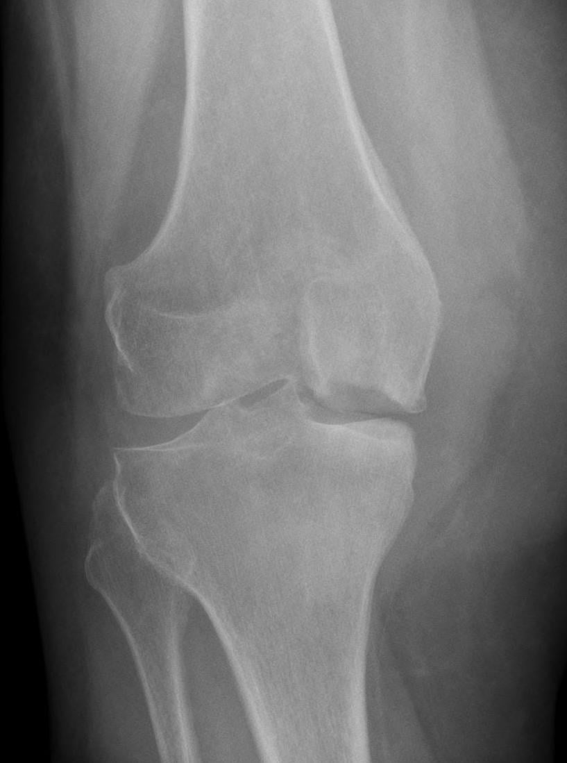 AP knee radiograph showing medial femoral condyle subchondral flattening and lucency in spontaneous osteonecrosis.