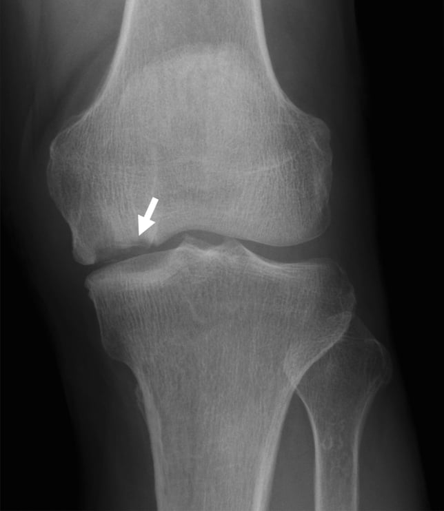 Weight-bearing AP knee radiograph showing a saucerised defect of the medial femoral condyle.