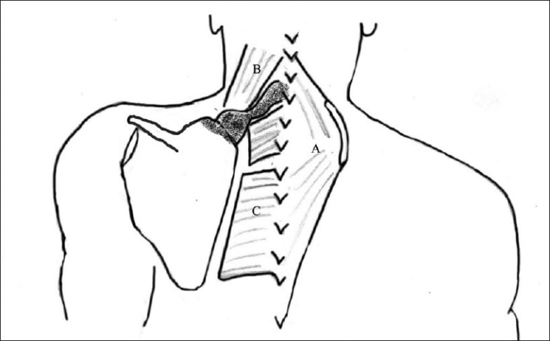 Green procedure diagram showing periscapular muscle release and shaded resection area in Sprengel deformity.
