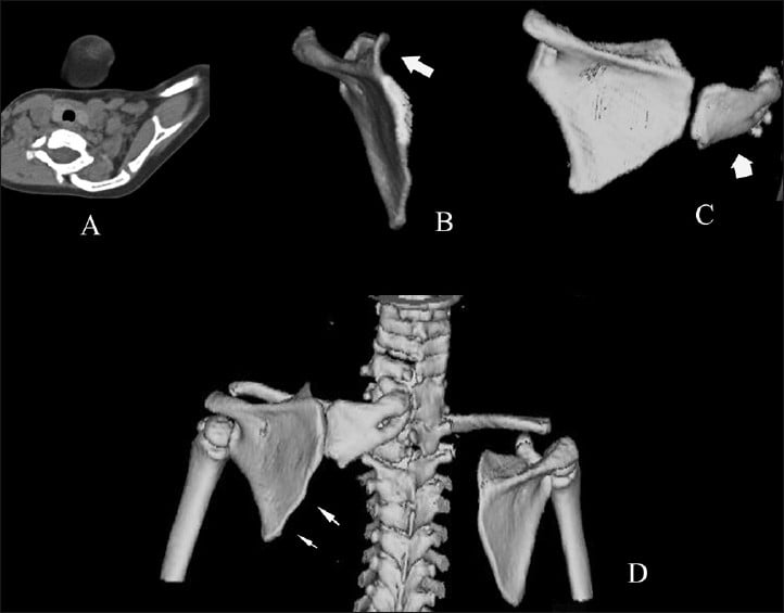 CT and 3D anatomy reconstruction showing omovertebral connection and abnormal scapular morphology in Sprengel deformity.