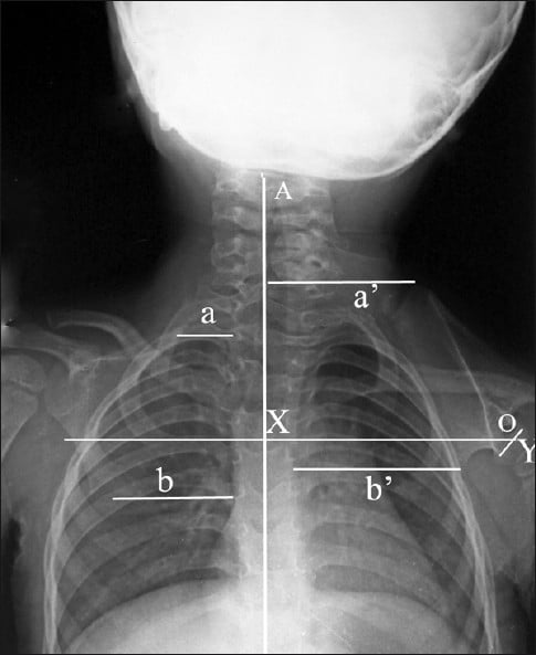 Frontal radiograph showing elevated scapula and Rigault-style measurement lines in Sprengel deformity.