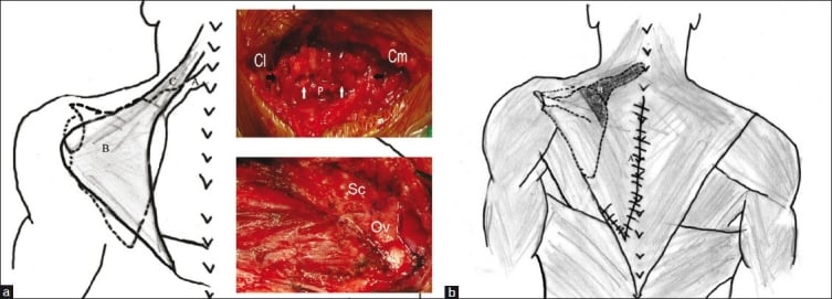 Woodward procedure diagram showing release of trapezius and rhomboid origins, omovertebral bar excision and inferior scapular relocation.