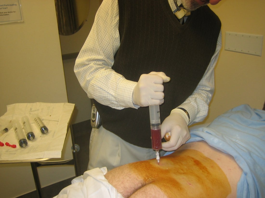 Clinician aspirating bone marrow from the posterior iliac crest with a syringe, collection tubes on the table.