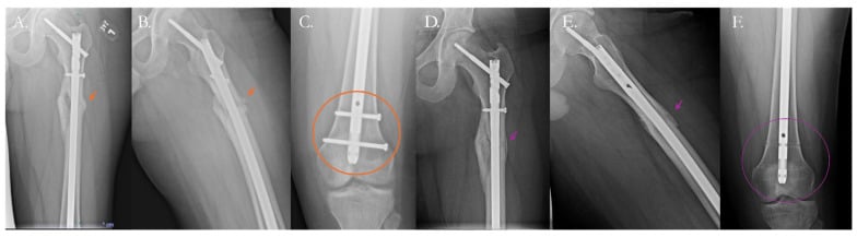 Femoral radiographs before and after BMAC with intramedullary nail dynamization for nonunion.