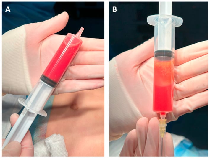 Lipoaspirate in the collection syringe and floating adipose tissue during sedimentation.