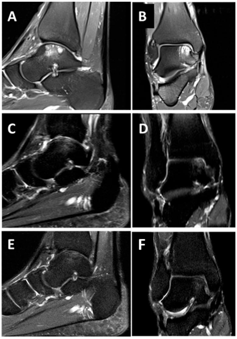 Serial ankle MRI of an osteochondral talar lesion before and after MSC-hydrogel treatment at 6 and 12 months.