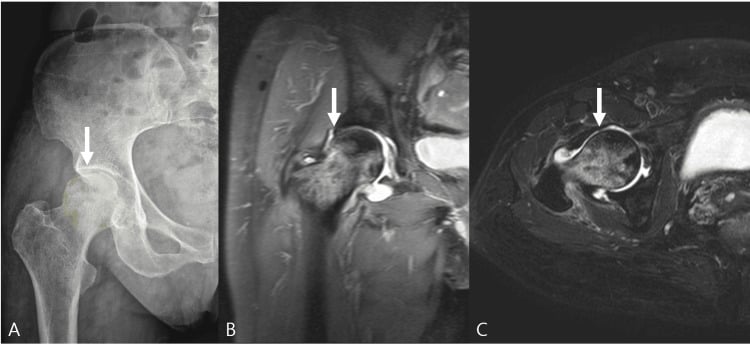 Pelvic radiograph and hip MRI showing early femoral-head osteonecrosis with subchondral collapse.