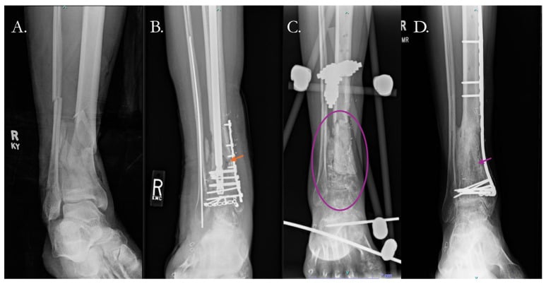 Pilon nonunion radiographs treated with induced membrane technique and local biologic therapy.