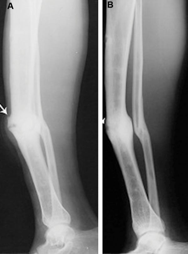 Lateral tibial radiographs before and six months after MSC with platelet-lysate product showing union.