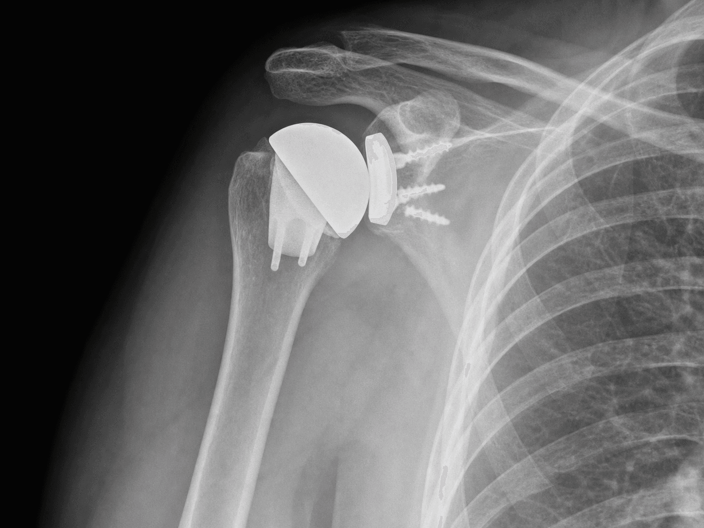 AP shoulder radiograph after stemless anatomic total shoulder arthroplasty showing a humeral component with no diaphyseal stem