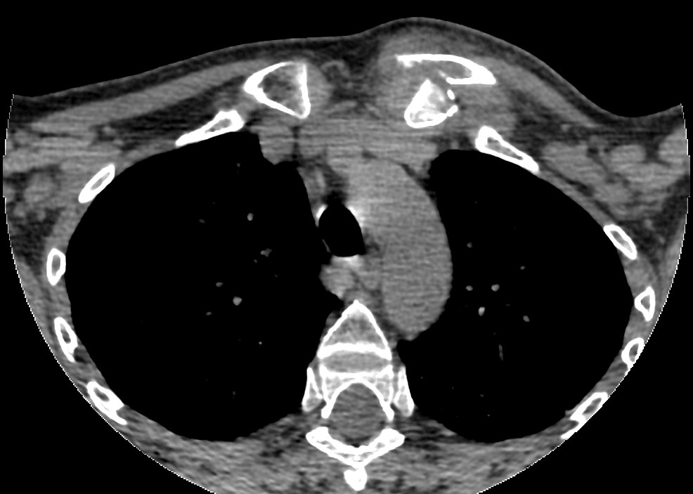 Axial chest CT at the sternoclavicular joints showing a left medial clavicle displaced relative to the manubrium.