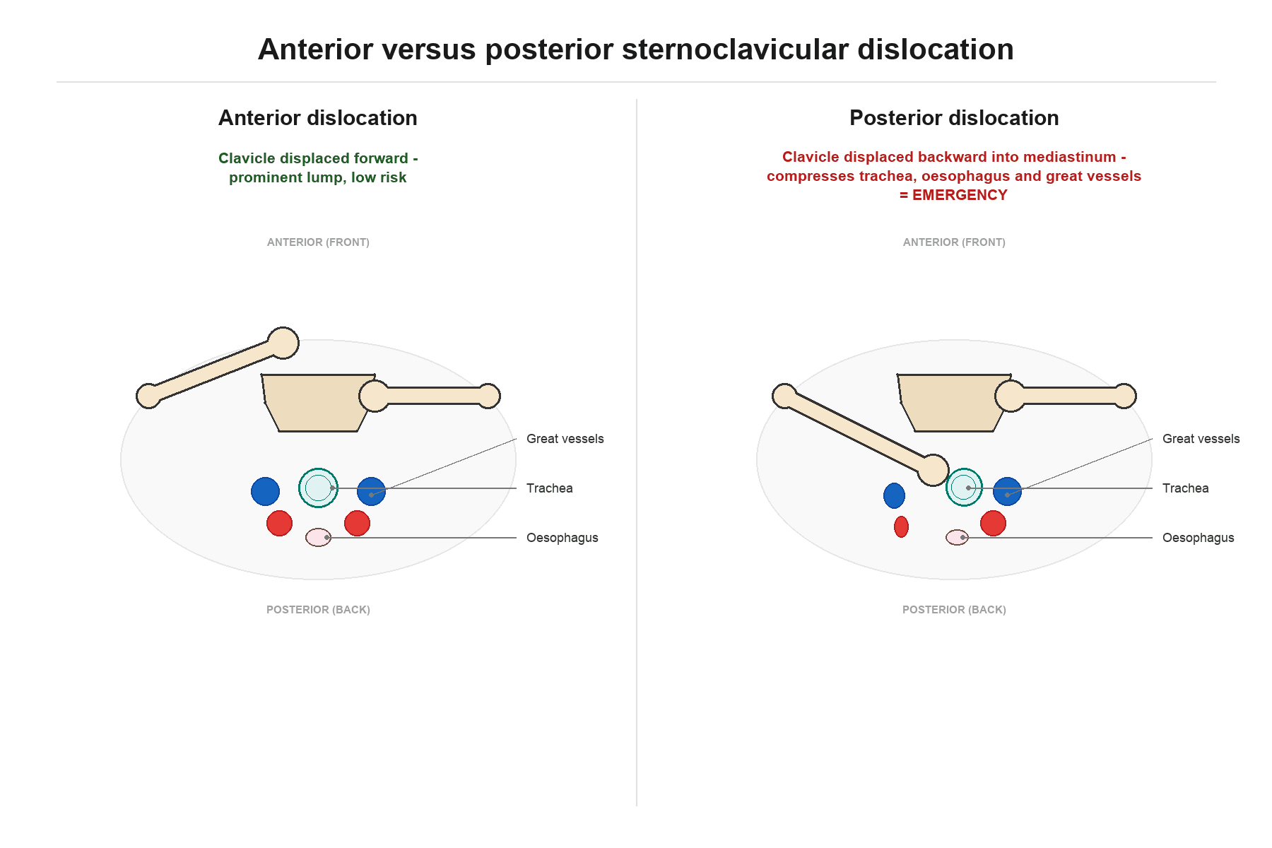 Axial diagram comparing anterior and posterior sternoclavicular dislocation and the mediastinal structures at risk